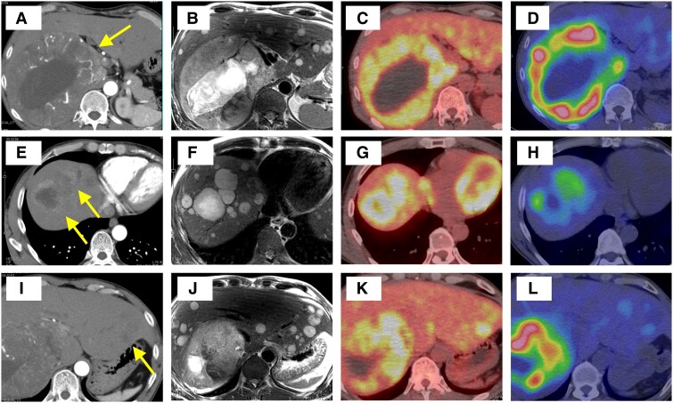Metastatic Pheochromocytoma/Paraganglioma Overproducing Multiple Catecholamines.
