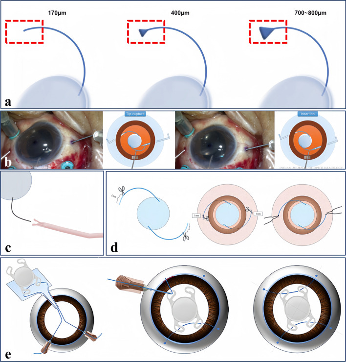 Recent advances and current challenges in suture and sutureless scleral fixation techniques for intraocular lens: a comprehensive review.