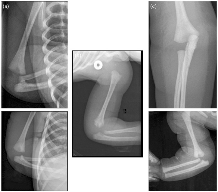 Management of the supposed elbow dislocation in newborns.