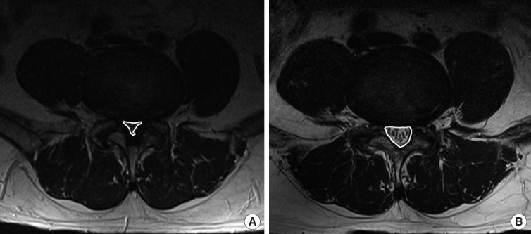 Comparative Outcomes of Biportal Endoscopic Decompression, Conventional Subtotal Laminectomy, and Minimally Invasive Transforaminal Lumbar Interbody Fusion for Lumbar Central Stenosis.