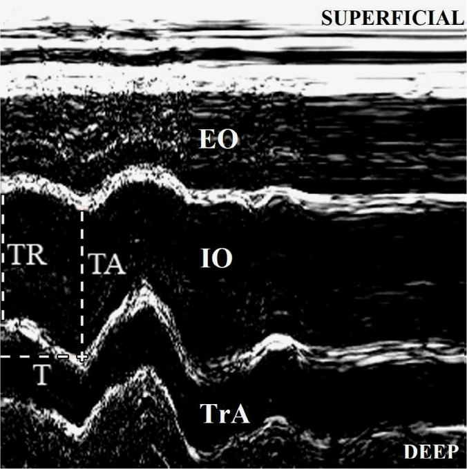 M-mode ultrasound evaluation of lateral abdominal muscle postural response to load: an exploratory study.
