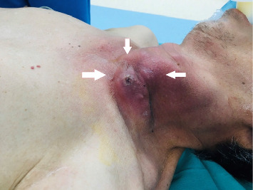 Lemierre's Syndrome Due to <i>Klebsiella pneumoniae</i> Results in Pulmonary Abscess Complications in a Patient With Diabetes: A Rare Case Report.
