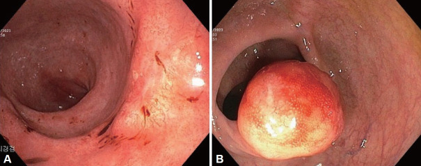 Gastric Subepithelial Lesion Accompanied by Colonic Subepithelial Mass.