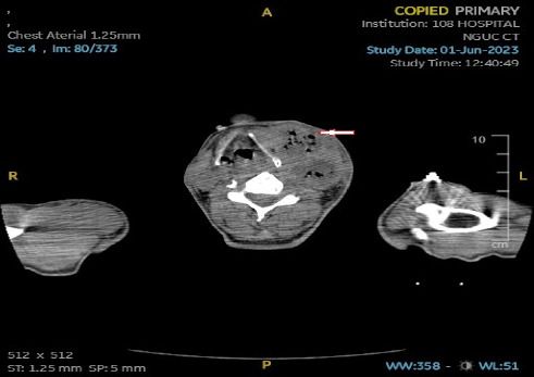 Lemierre's Syndrome Due to <i>Klebsiella pneumoniae</i> Results in Pulmonary Abscess Complications in a Patient With Diabetes: A Rare Case Report.