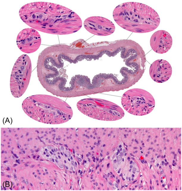 Persistent abdominal distension, bilious emesis, and feeding intolerance in an infant without anatomical bowel obstruction.