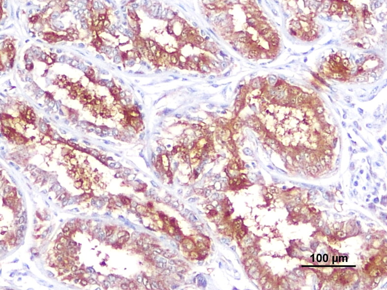 TGFβ in malignant canine mammary tumors: relation with angiogenesis, immunologic markers and prognostic role.