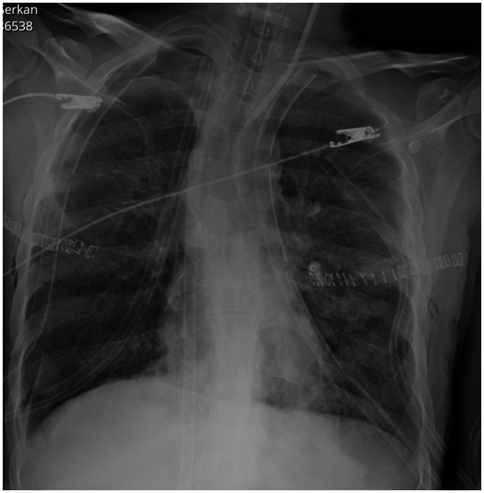 Multiple life-threatening complications in a patient who received lung transplantation due to cystic fibrosis and their management.