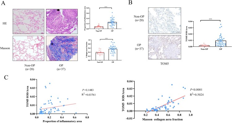 TOM5 regulates the mitochondrial membrane potential of alveolar epithelial cells in organizing pneumonia.