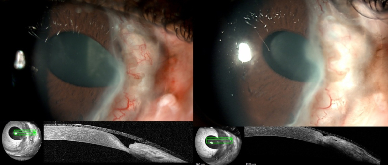 Long-term Results of Topical Insulin Treatment for Persistent Corneal Epithelial Defects.