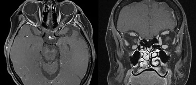 Acute Myelin Oligodendrocyte Glycoprotein-IgG Optic Neuritis without Optic Nerve Enhancement.