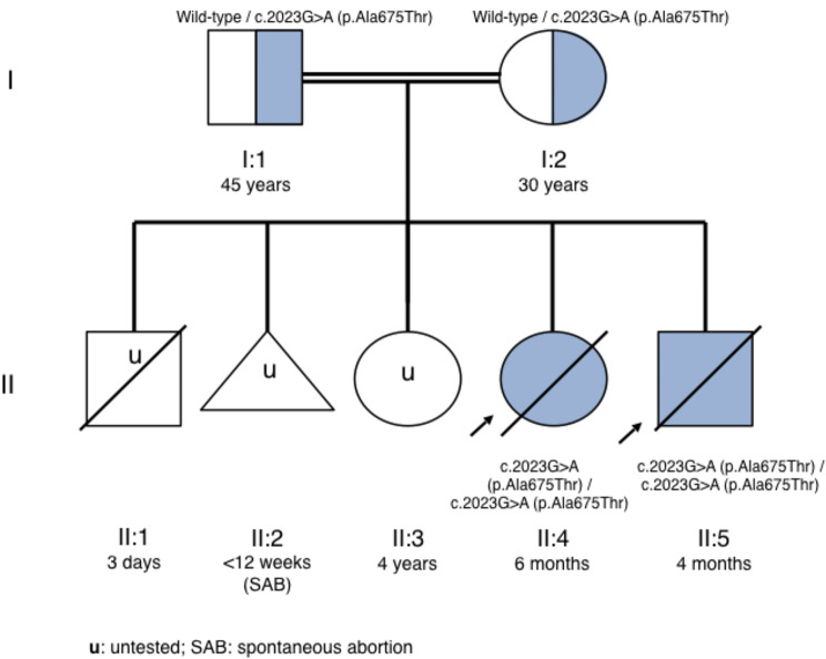 Aicardi-Goutières syndrome type 6: report of ADAR variant and clinical outcome after ruxolitinib treatment in the neonatal period.