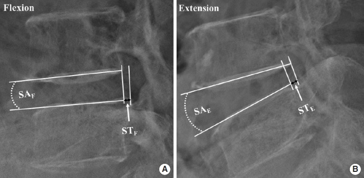 Comparative Outcomes of Biportal Endoscopic Decompression, Conventional Subtotal Laminectomy, and Minimally Invasive Transforaminal Lumbar Interbody Fusion for Lumbar Central Stenosis.