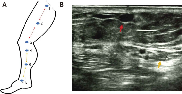 Quantitative Evaluation of Peripheral Nerve Injury in Endovenous Laser Ablation with or without Microphlebectomy: Prospective Cohort Study of 25 Cases.