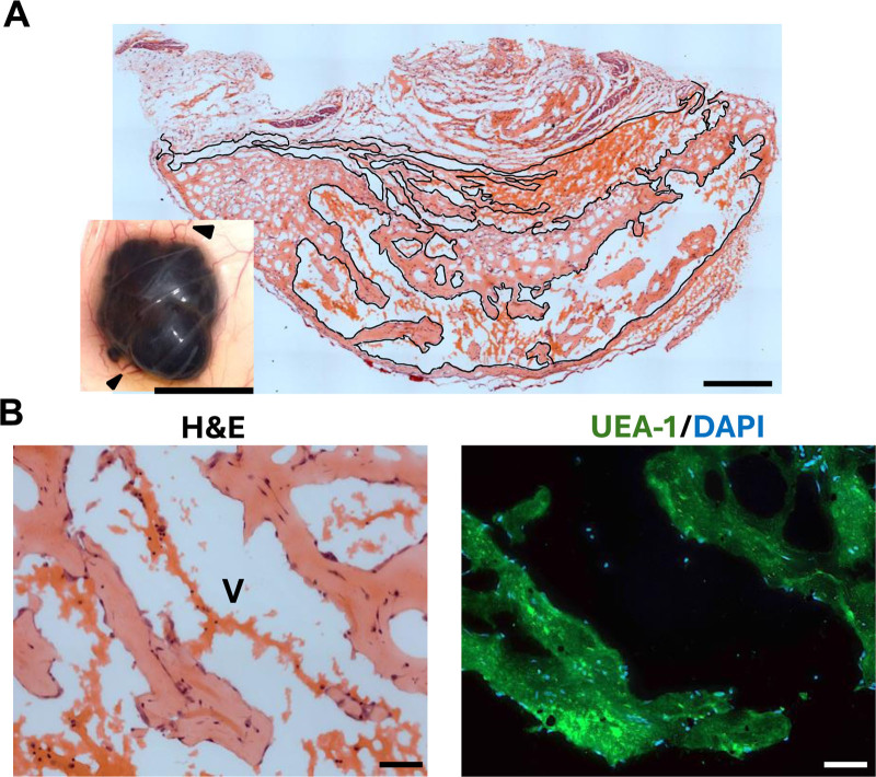 Size-dependent Nanoparticle Accumulation In Venous Malformations.