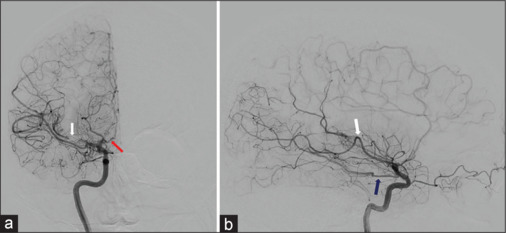 Moyamoya disease manifesting with bilateral involvement of the proximal vertebral arteries: A case report.