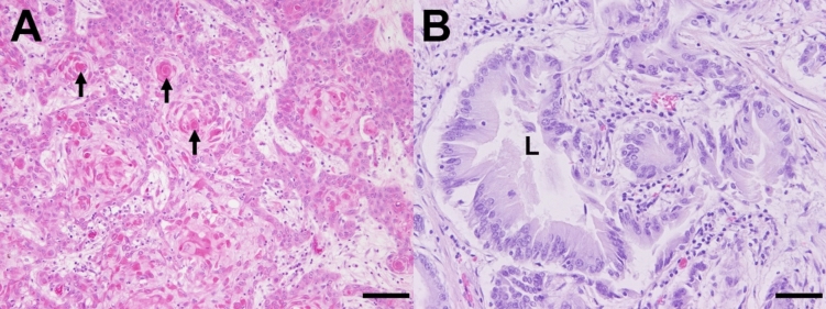 Adenocarcinoma and squamous cell carcinoma associated with gastric ulcers in alpacas.