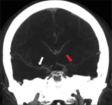 Moyamoya disease manifesting with bilateral involvement of the proximal vertebral arteries: A case report.