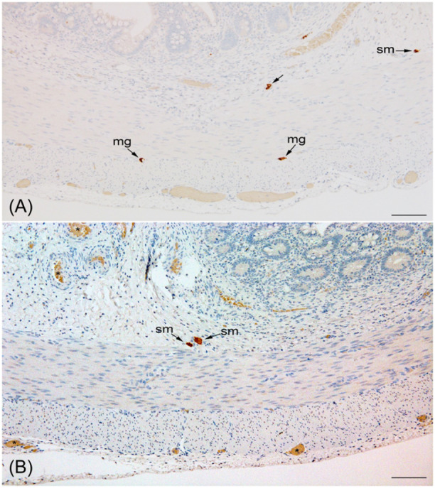 Persistent abdominal distension, bilious emesis, and feeding intolerance in an infant without anatomical bowel obstruction.