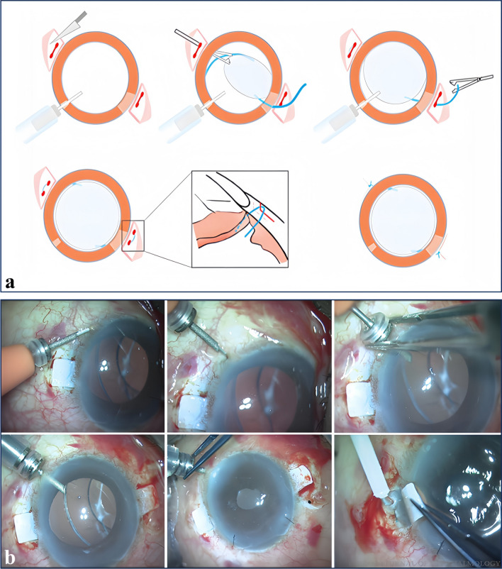 Recent advances and current challenges in suture and sutureless scleral fixation techniques for intraocular lens: a comprehensive review.