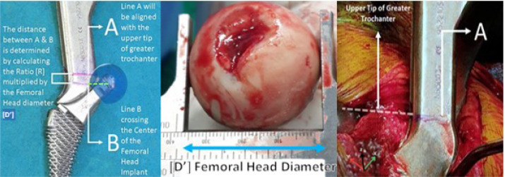 Greater Trochanter Tip as an Anatomical Reference to Minimize Leg Length Discrepancy following Hip Arthroplasty.