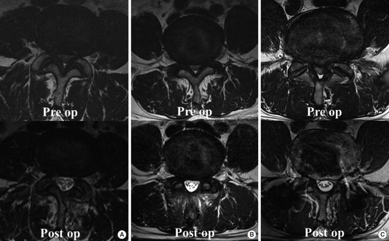 Comparative Outcomes of Biportal Endoscopic Decompression, Conventional Subtotal Laminectomy, and Minimally Invasive Transforaminal Lumbar Interbody Fusion for Lumbar Central Stenosis.