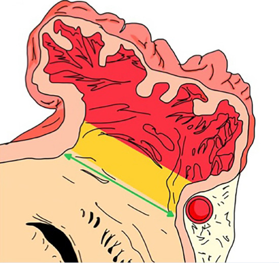 [Surgical closure of the left atrial appendage in cardiac surgery: a review article].