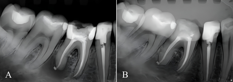 Twelve-month healing rates after endodontic therapy with foraminal cleaning using 2% chlorhexidine in mandibular molars diagnosed with apical periodontitis: a prospective clinical study.