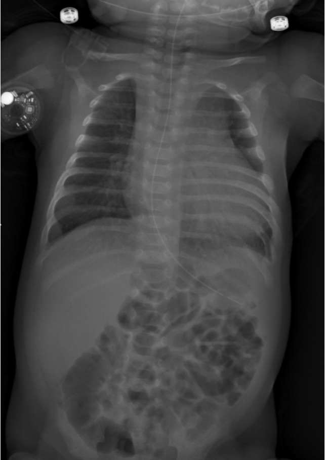 Diazoxide toxicity in congenital hyperinsulinism: A case report.