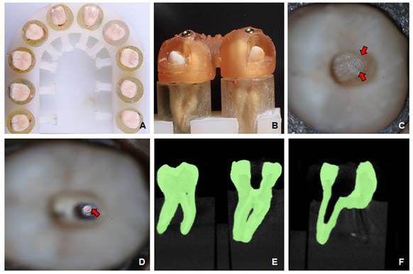 Effect of Fiberglass Post Technique Removal on the Root Dentin Loss, the Root Canal Alignment and the Root Perforation Occurrence.