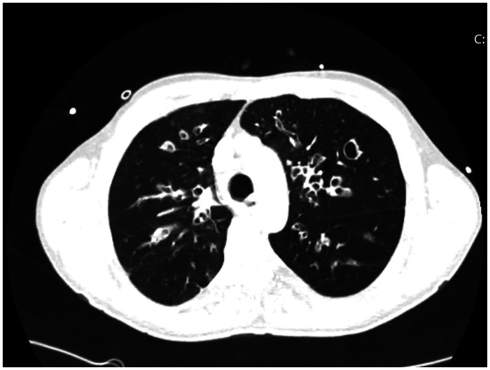 Multiple life-threatening complications in a patient who received lung transplantation due to cystic fibrosis and their management.