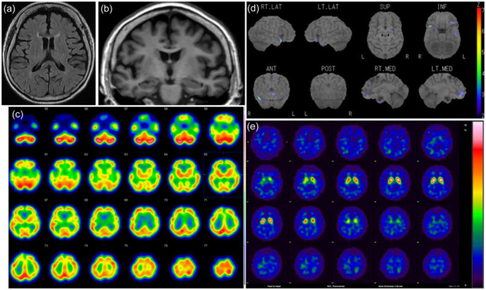 The impacts of hospital admission in very late-onset schizophrenia-like psychosis: A case report.