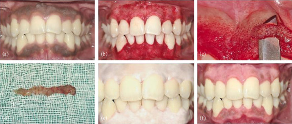 Vitamin C-Based Gingival Depigmentation Versus Surgical Depigmentation: A Randomized Clinical Trial.