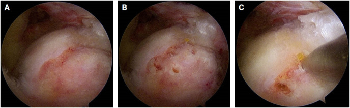 Factors affecting healing of rotator cuff repairs: microfracture of the greater tuberosity.