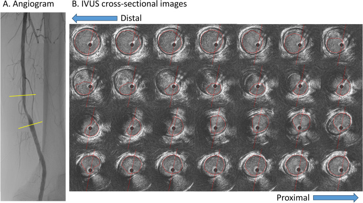 Intravascular ultrasound-derived virtual fractional flow reserve in the superficial femoral artery.