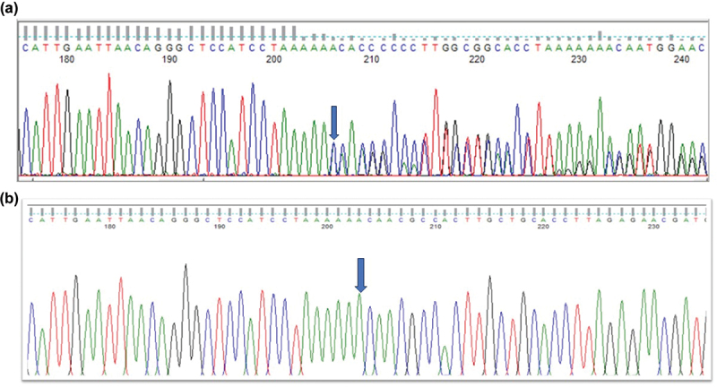A novel frameshift variant in <i>BCOR</i> causes congenital nuclear cataract.