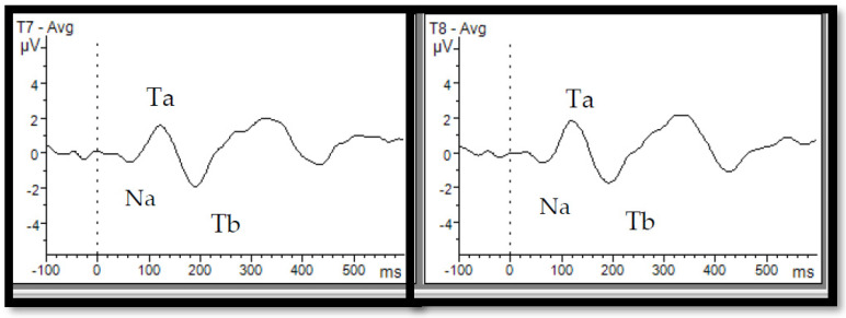 Temporal and Fronto-Central Auditory Evoked Responses in Children with Neurodevelopmental Disorders: A Scoping Review.