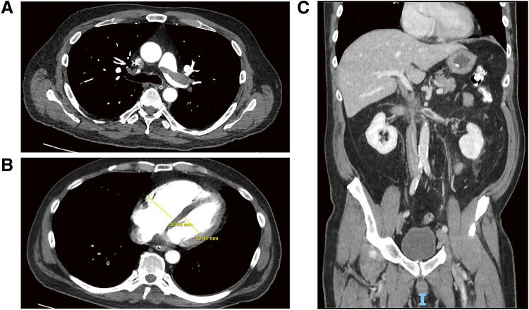 Clearing Disseminated Venous Thromboembolism in a Single Procedure Using Thrombolytic-Free Large Bore Suction Thrombectomy: A Versatile Toolbox to Unclog the Venous Circulation.