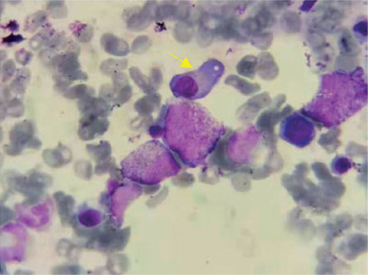 <i>CSF3R</i> Gln776X and <i>ASXL1</i> mutations in multiple myeloma associated with chronic neutrophilic leukemia: case report and literature review.