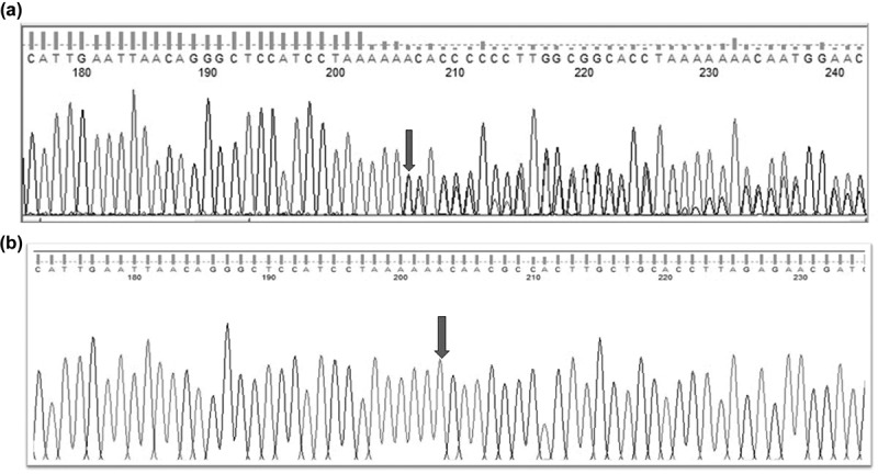 A novel frameshift variant in <i>BCOR</i> causes congenital nuclear cataract.