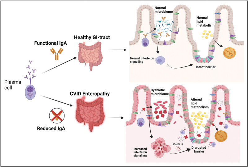 Paucity of gastrointestinal plasma cells in common variable immunodeficiency.