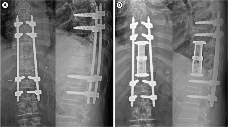 Spinal Cord Injury From Tuberculous Spondylitis Misdiagnosed as Metastatic Spinal Tumor and Bacterial Spondylitis: A Case Report & Literature Review.