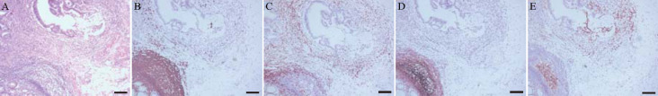 [Clinical significance of tertiary lymphoid structure maturity in colorectal cancer patients].