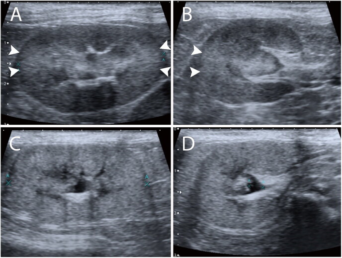 Correlation between change in serum creatinine concentration and renal cortical anisotropic backscattering artifact in azotemic cats during hospitalization.