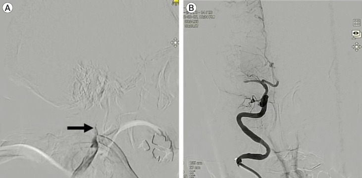 Novel use of a stent retriever as a distal filler protection device for prevention of secondary embolization.