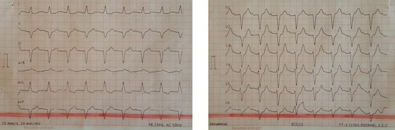 Sustained Ventricular Tachycardia as the first presentation of transthyretin amyloid cardiomyopathy.