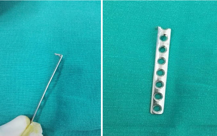 Internal Fixation for Unstable Distal Ulnar Fractures by 2.7 mm Semitubular Hook Plate.