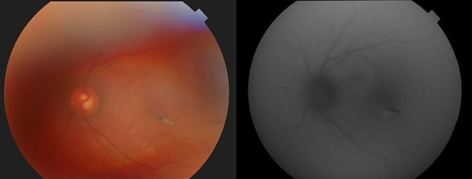 An Unusual Case of Low Vision and Anisocoria Considered a Neurological Finding in the Emergency Department: Ocular Siderosis.