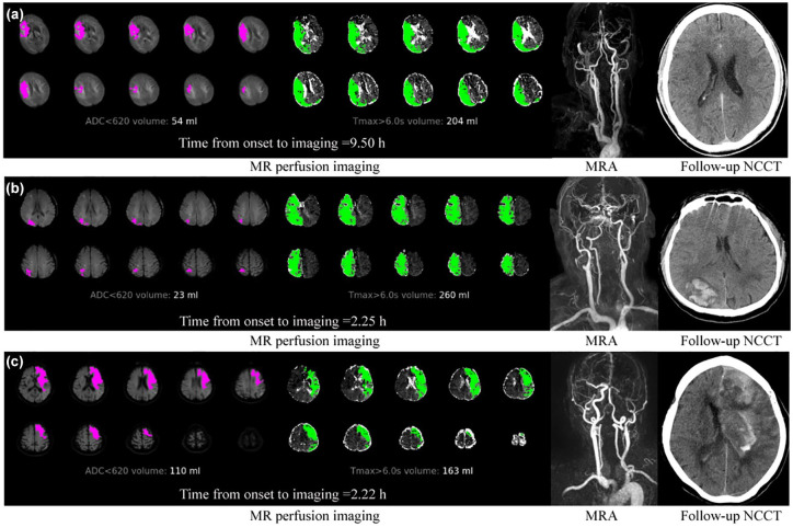 Early infarct growth rate is associated with symptomatic intracranial hemorrhage after endovascular thrombectomy.