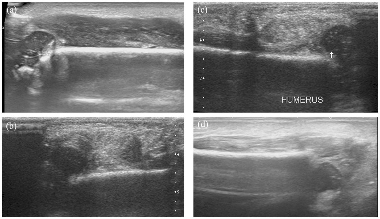 Management of the supposed elbow dislocation in newborns.