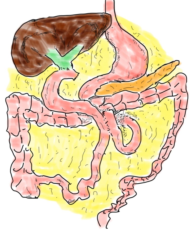 Laparoscopic Hepaticojejunostomy. Initial experience in 21 consecutive cases.